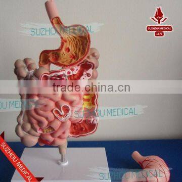 Pathological stomach model