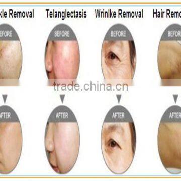Portable IPL SHR SSR Hair Removal Skin Rejuvenation Pigmentation&Vascular&Acne&Spot Removal Beauty Salon Equipment&Machine