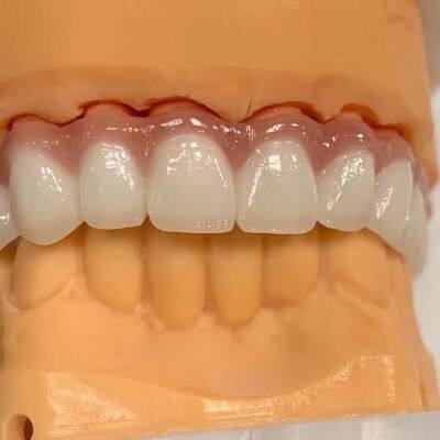 China Screw Retained Implant BridgeGood quality comes initial