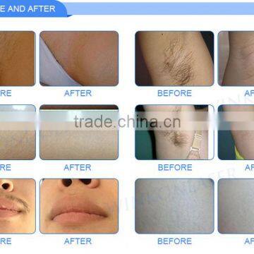 Germany Laser 808nm Hair Removal Machine With 4 in 1 Cooling System photo-6