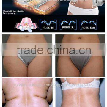 2015 Radio Frequency Rolling Guangzhou Beauty FSWT Machine Wholesaler photo-3