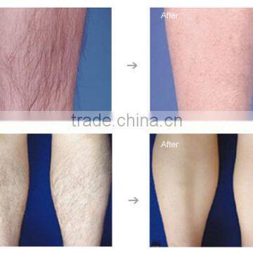 e Light Ipl rf nd Yag Laser Spot and Freckle Removal Machine photo-4