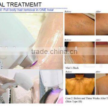 KLSI Mini Laser Hair Removal photo-3