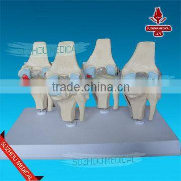 Set of 4 knee joint models