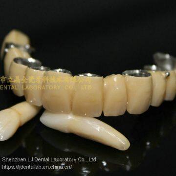 Dental crown composite, dental teeth, dental prosthesis, laboratoire dentaire, Dentallabor, laboratorio dental, dental laboratory, Shenzhen LJ dental lab China