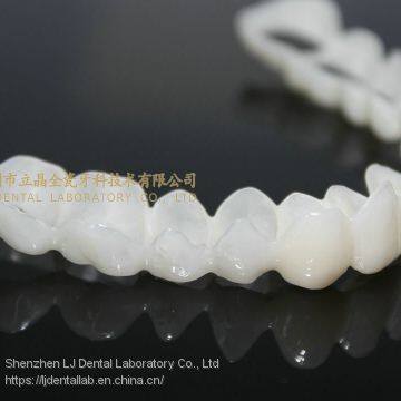 CAD/CAM PMMA Resin Clip on Veneers, Snap-on-veneers, Smile Veneers, Laboratoire Dentaire, Dentallabor, Laboratorio Dental, Dental Laboratory, Shenzhen LJ Dental Lab China