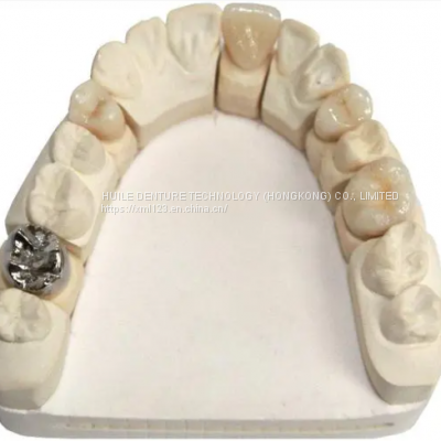 METAL CROWN Dental Pfm Crown From China Dental Lab