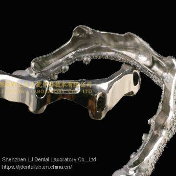 Dental Implant Bar, Implant Overdenture, Implant Prosthesis, Laboratoire Dentaire, Dentallabor, Laboratorio Dental, Dental Laboratory, Shenzhen LJ Dental Lab China photo-2