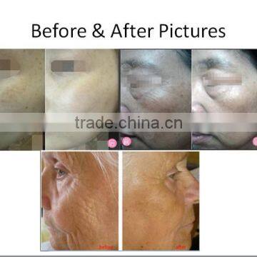 BP001B-galvanic Technology Eye Wrinkle Remove Galvanic Skin Tightening Machine