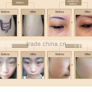 800mj New Styel Laser Picosure/laser Tattoo Removal Machine Price Pigmented Lesions Treatment photo-5