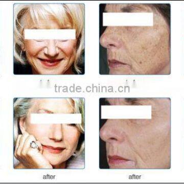 High Quality Photodynamic Therapy photo-5