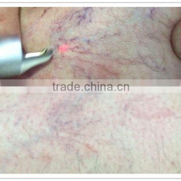 diode laser 980nm vascular vein stopper spider vein / laser vascular removal machine for face