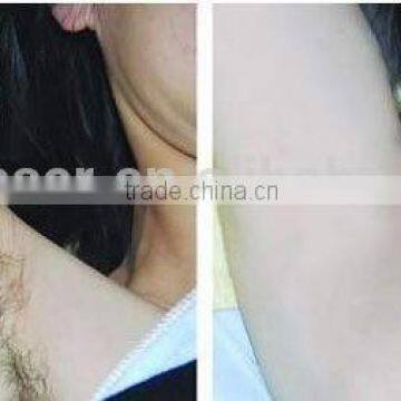 QTS Alexandrite Laser Hair Removal Machine Price With CE photo-3