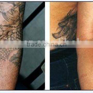 Q-switched Ndyag Laser,professional for Tattoo,pigment ,eyebrow Removal photo-6