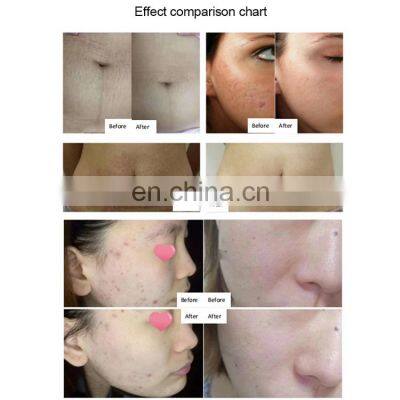 Hifu Vaginal Tightening And Microneedling Machine Mini Hifu For Skin Tightening photo-4