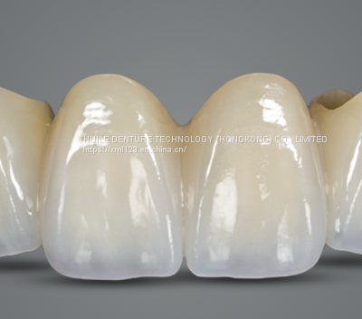 Dental Porcelain Gold Crown/Precious metal Crown China Outsourcing Dental Lab