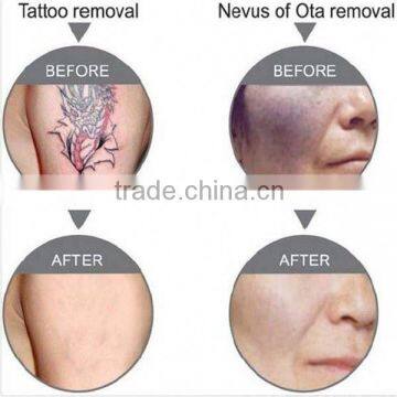 Super Fast Color Touch Screen Logo Customized 10HZ nd Yag Laser Tattoo Removal System photo-6