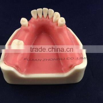 medical science dental implant model with soft gingiva