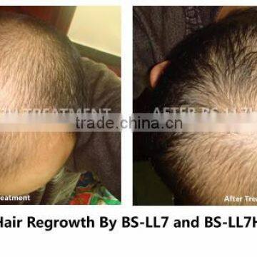 Laser Hair Loss Treatment/ Hair Growth Machine/ Laser Hair Regrowth Massage Machine From Factory Direct Sales