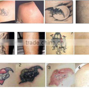 532nm 1064nm Laser Tattoo Removal Nd Laser Machine For Tattoo Removal Yag Laser Tattoo Removal Machine 800mj photo-6