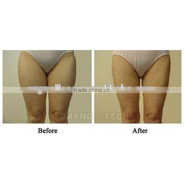 High Frequency  Portable Liposonix 500000 Shot Hips Shaping Times HIFU Body Slimming Machine Pain Free photo-6