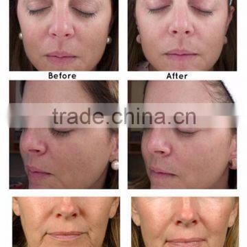 High Intensity Focused Ultrasound 2016 New High Intensity Focused Ultrasound HIFU HIFU Machine Forehead Wrinkle Removal