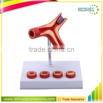 Thrombus Education Biological Teaching Human Body Anatomy Model