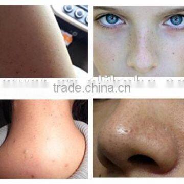 2017 Most Popular Blackhead Remover Vacuum Blackhead Remover photo-6
