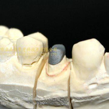 Full metal post core, full ceramic post core, richmond crown, cast metal crown, dental prostheses, laboratorio dental, dental laboratory, Dentallabor, LJ dental lab China