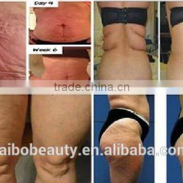 Vacuum Cold Zero Cryo Lipo Laser Machine/cryo Slimming Machine/cryo Liposuction Machine photo-5