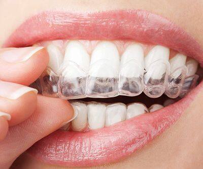 Custom Upper and Lower Teeth Retainer | Perfect Fit at-Home Kit for Replacement Retainers | Clear Dental Retainer for Teeth Stability