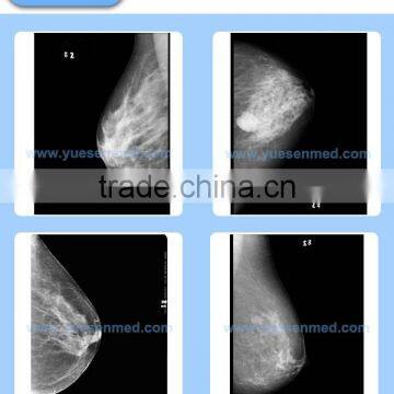 High Frequency Fixed or Rotating Anode Cheapest Mammography x Ray Price