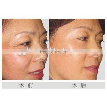New Designed Bipolar RF Skin Tightening Face Lifting Beauty Equipment Price photo-5