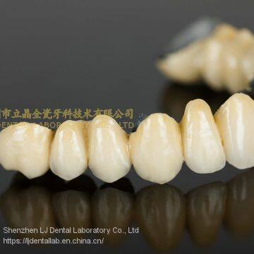 Dental Crown Porcelain Fused Metal, PFM, VMK, Dental Prostheses, Laboratoire Dentaire, Dentallabor, Laboratorio Dental, Dental Laboratory, Shenzhen LJ Dental Lab China
