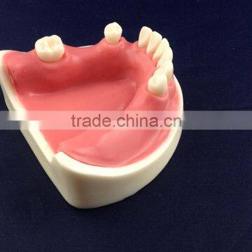Medical Science Dental Implant Model With Soft Gingiva photo-6