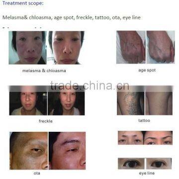 Professional Mini C6 High Energy Beauty Equipment For Body Rejuvenation Speckle Removal And Freckle Removal photo-5