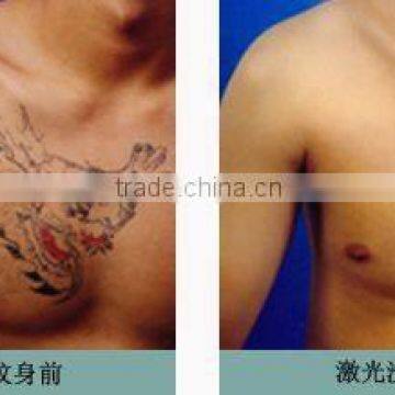 Q Switch Nd Yag Pigmented Lesions Treatment Laser Price 1064nm &532nm Wavelength Laser Removal Tattoo Machine