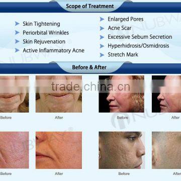 Best Laser Fractional Scarlet&wrinkle Removal&skin Rejuvenation Device photo-4