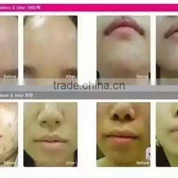 Red Led Light Therapy Skin Korea Led Anti-aging Light Pdt Machine Facial Led Light Therapy photo-2