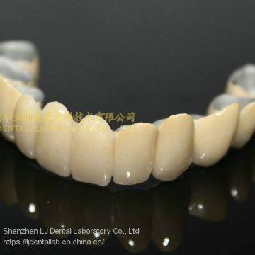 Dental Crown Porcelain Fused Metal, PFM, VMK, Dental Prostheses, Laboratoire Dentaire, Dentallabor, Laboratorio Dental, Dental Laboratory, Shenzhen LJ Dental Lab China photo-2