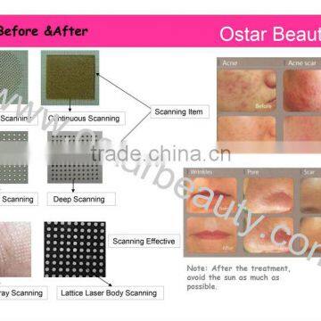 Medical Co2 Laser Machine for Scar Removal photo-3