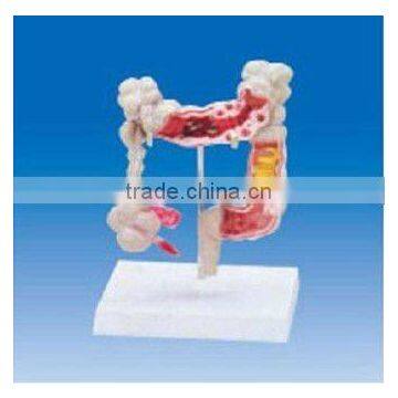 Colon and rectum model ,Colon and rectum common disease model