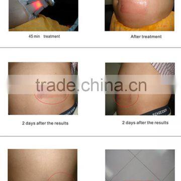 2016 Cryo Freeze Fat Cell Cooling Body Slimming Machine photo-2