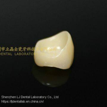 Dental Crown Zirconia PFZ, Dental Teeth, Dental Prosthesis, Laboratoire Dentaire, Dentallabor, Laboratorio Dental, Dental Laboratory, Shenzhen LJ Dental Lab China photo-2