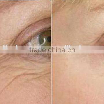 2016 Newest Portable Fractional RF Machine Radio Frequency/Best RF Skin Tightening Face Lifting Machine photo-6