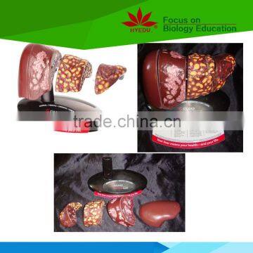 Hot selling Medical teaching human 4-stage liver model