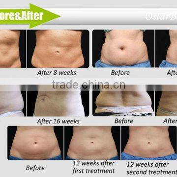 Hot Sale Freezing Fat Slimming Machine Medical photo-6