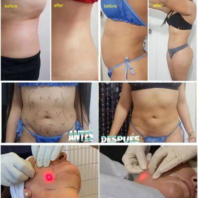 FDA-Compliant Hair Removal Laser for Spa and Beauty Centers