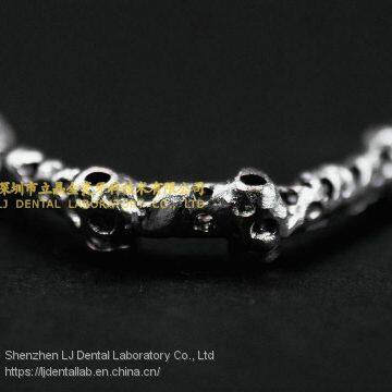 Dental implant bar, implant overdenture, implant prosthesis, laboratoire dentaire, Dentallabor, laboratorio dental, dental laboratory, Shenzhen LJ dental lab China