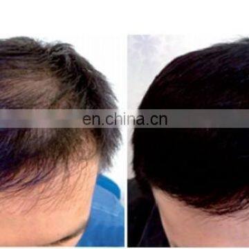 Low Level Laser Hair Growth Helmets 650nm Hair Growth Led Light and Fda photo-6